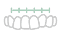 dente-desalinhado